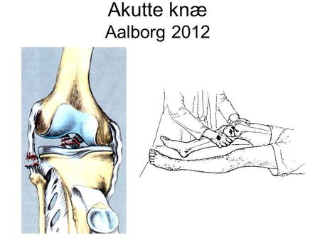 Akutte knæ Aalborg 2012.