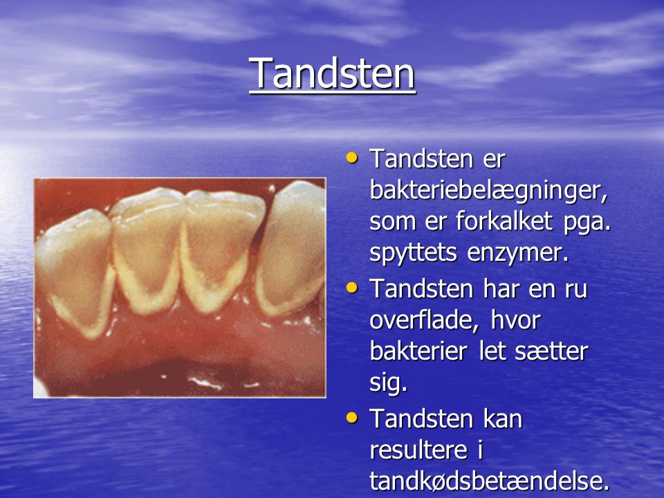 Tandsten Tandsten er bakteriebelægninger, som er forkalket pga. spyttets enzymer. Tandsten har en ru overflade, hvor bakterier let sætter sig.