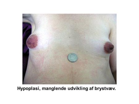 Hypoplasi, manglende udvikling af brystvæv.