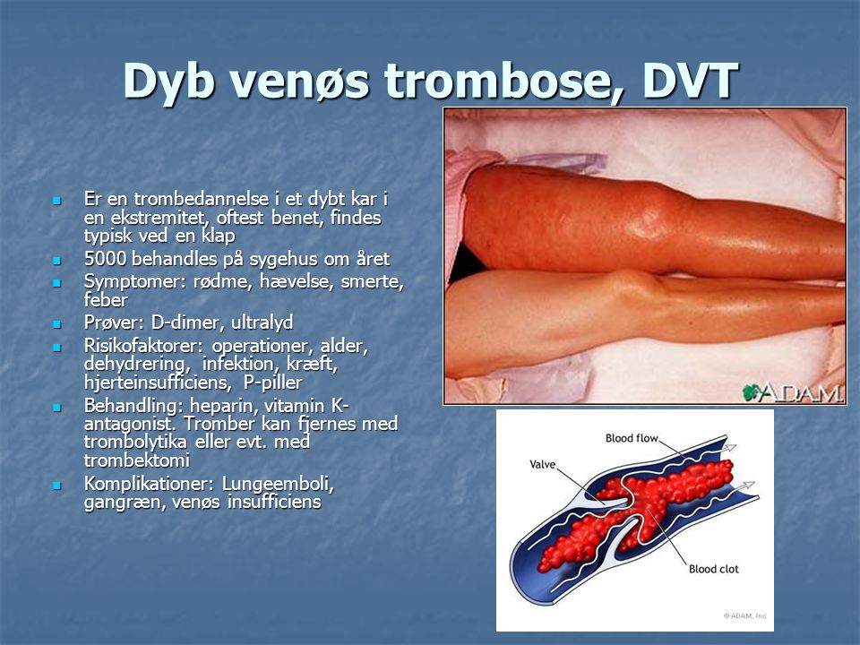 Dyb venøs trombose, DVT Er en trombedannelse i et dybt kar i en ekstremitet, oftest benet, findes typisk ved en klap.