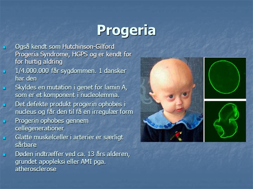 Progeria Også kendt som Hutchinson-Gilford Progeria Syndrome, HGPS og er kendt for for hurtig aldring.