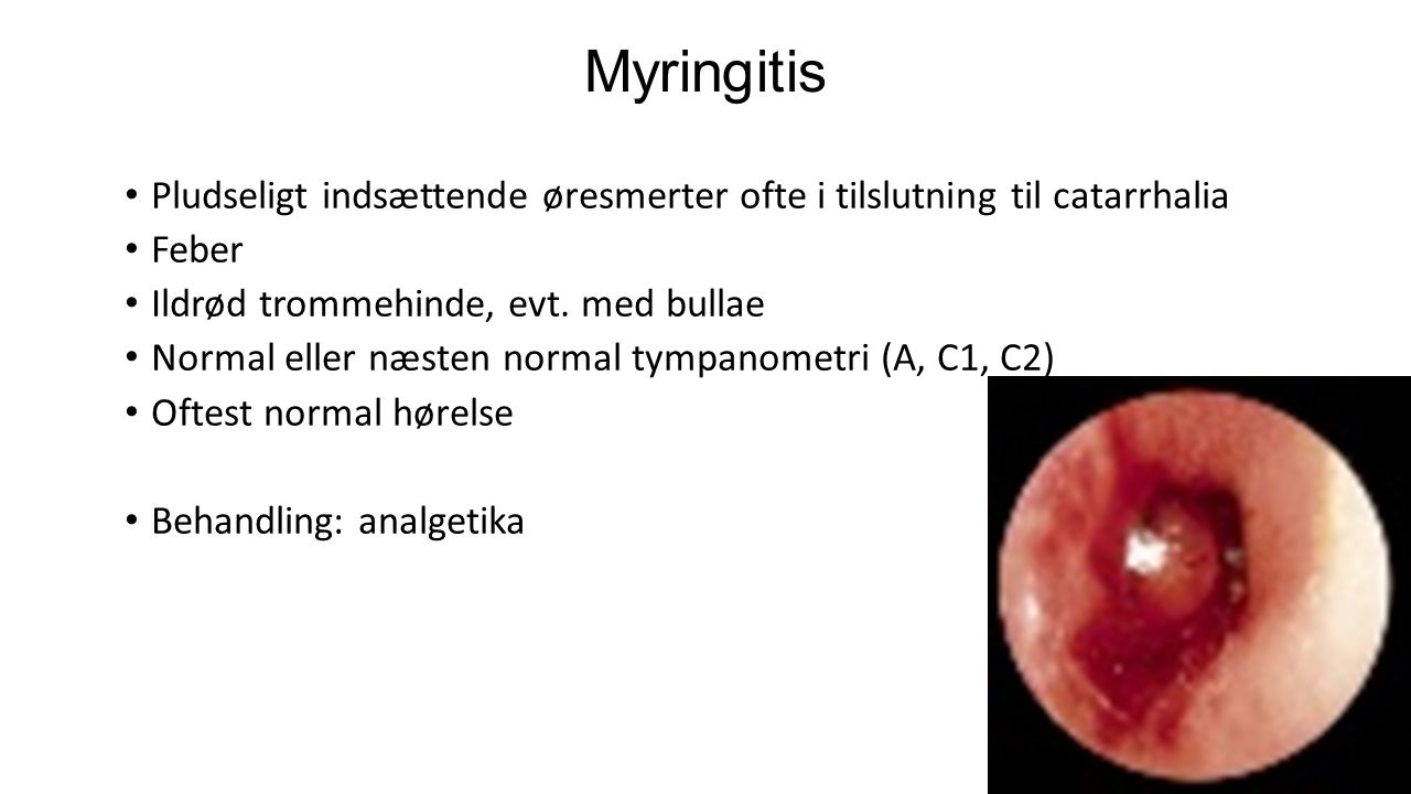 Myringitis Pludseligt indsættende øresmerter ofte i tilslutning til catarrhalia. Feber. Ildrød trommehinde, evt. med bullae.
