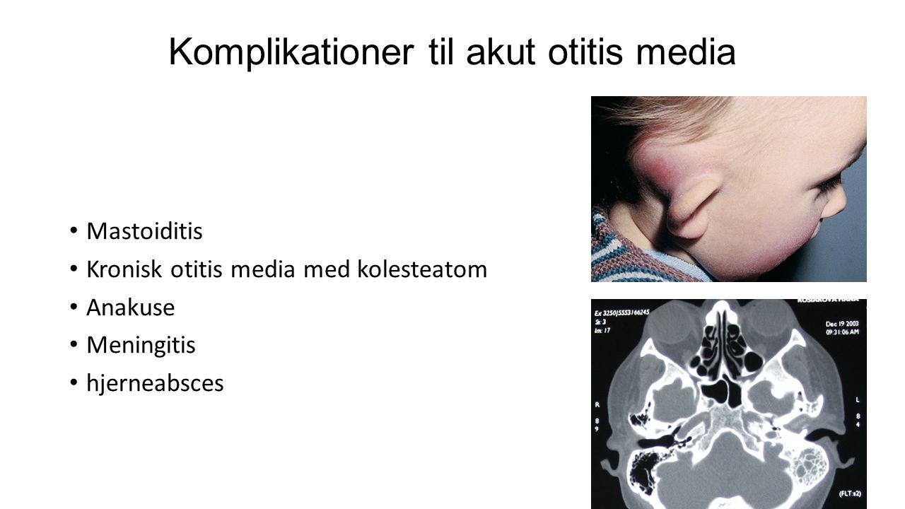 Komplikationer til akut otitis media