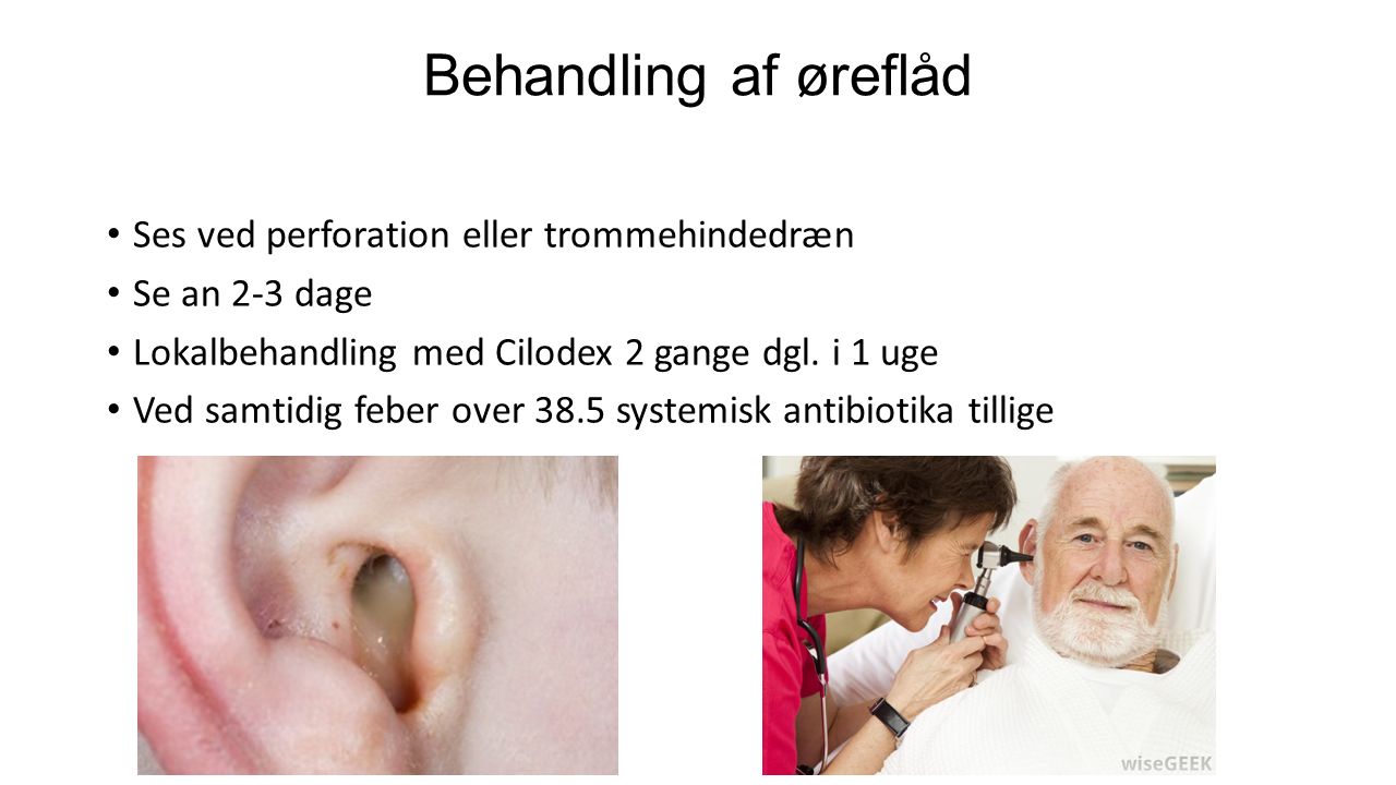 Behandling af øreflåd Ses ved perforation eller trommehindedræn