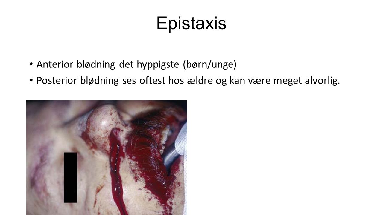 Epistaxis Anterior blødning det hyppigste (børn/unge)