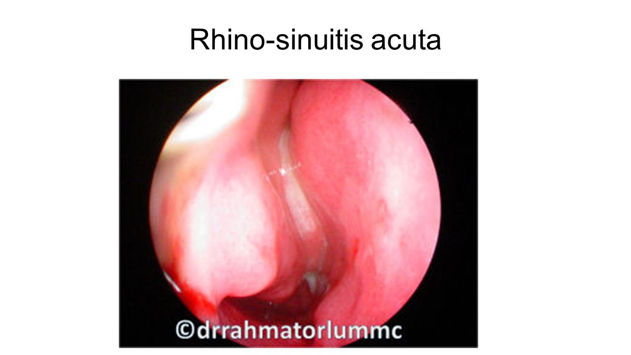 Rhino-sinuitis acuta