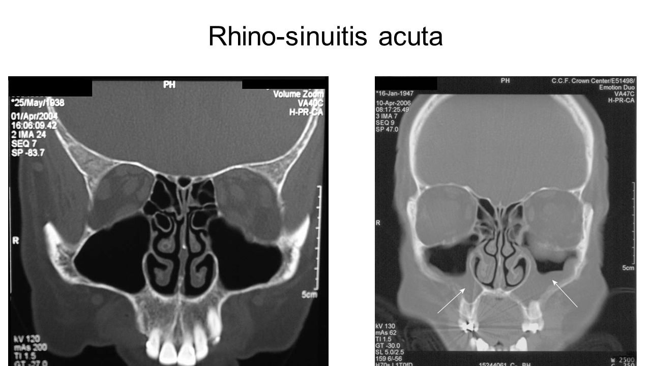Rhino-sinuitis acuta