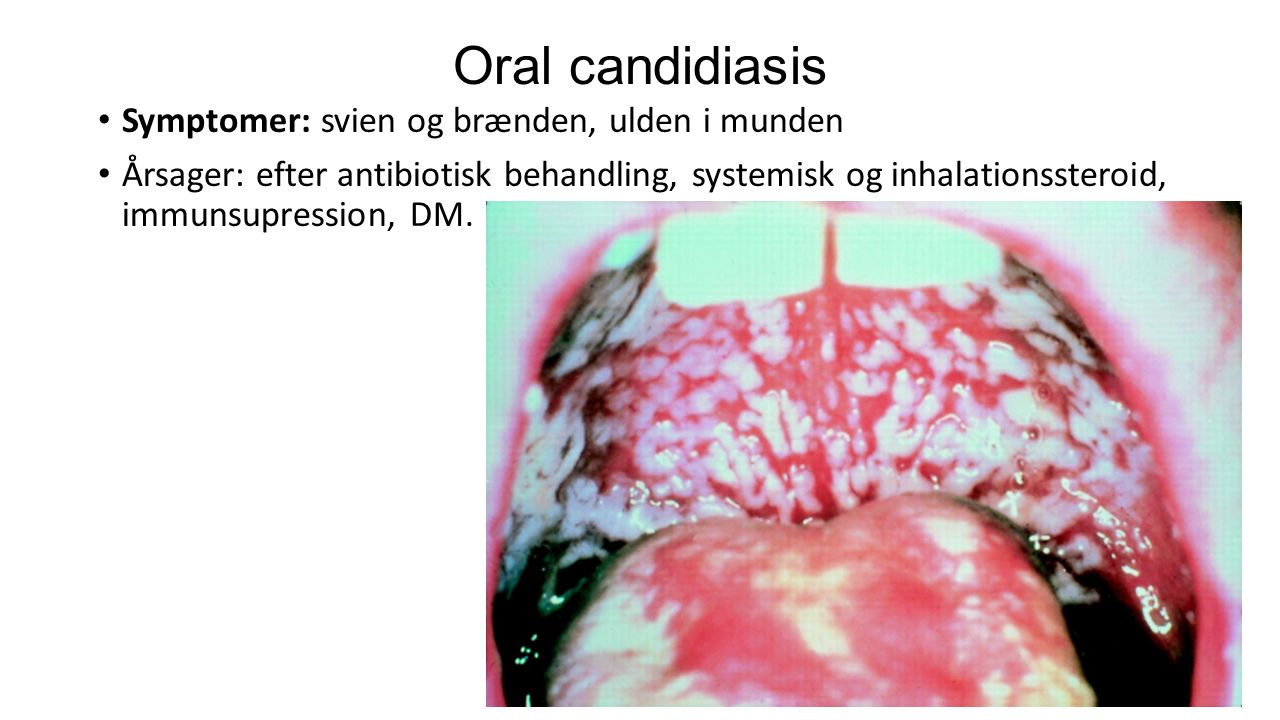 Oral candidiasis Symptomer: svien og brænden, ulden i munden