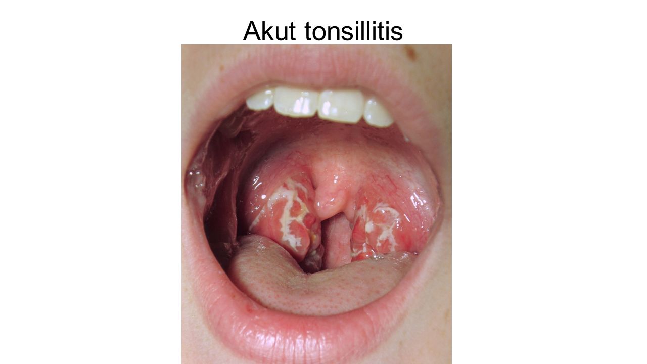 Akut tonsillitis