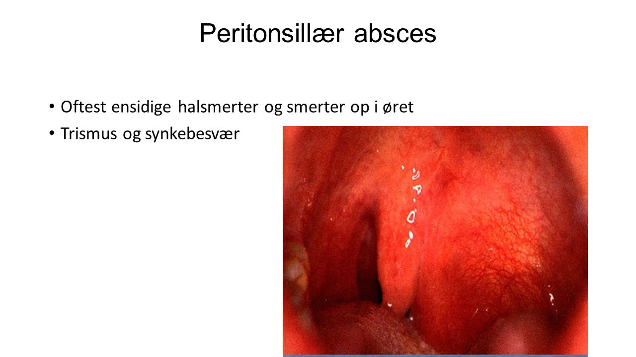 Peritonsillær absces Oftest ensidige halsmerter og smerter op i øret