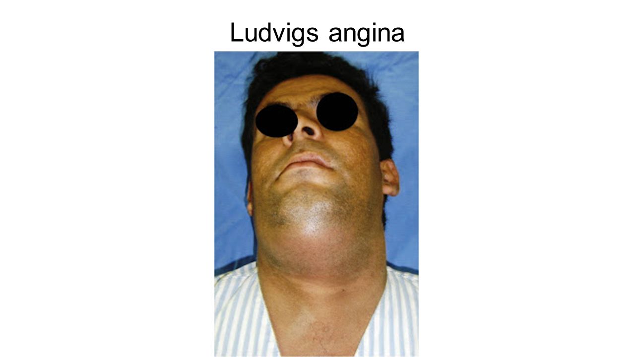 Ludvigs angina