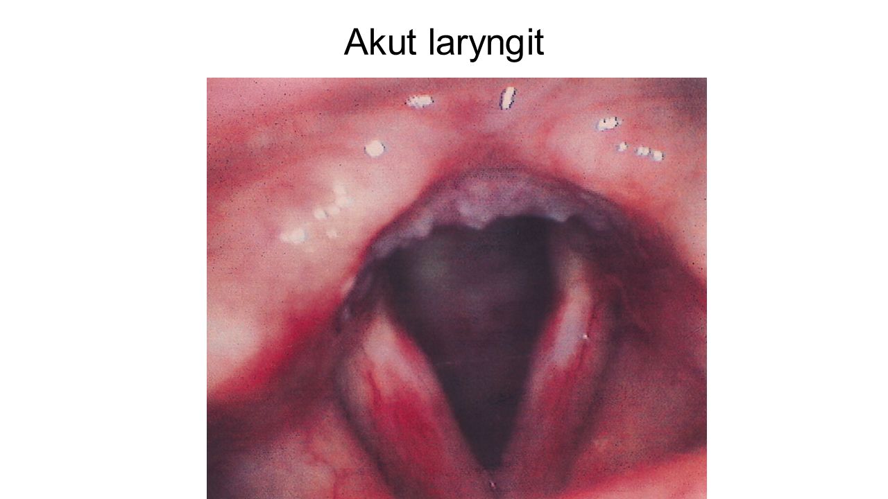 Akut laryngit