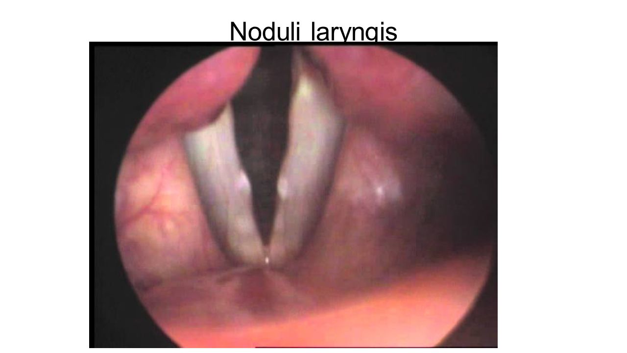 Noduli laryngis