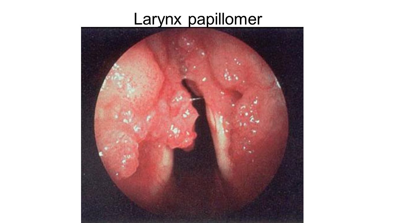 Larynx papillomer