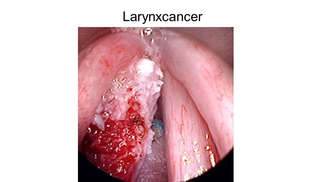 Larynxcancer