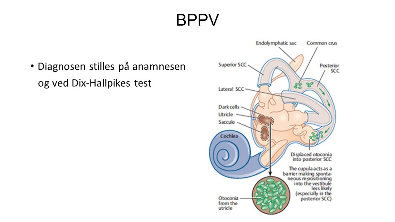 BPPV Diagnosen stilles på anamnesen og ved Dix-Hallpikes test