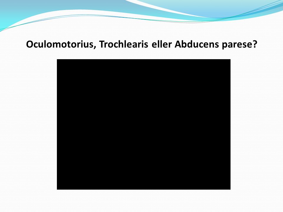 Oculomotorius, Trochlearis eller Abducens parese