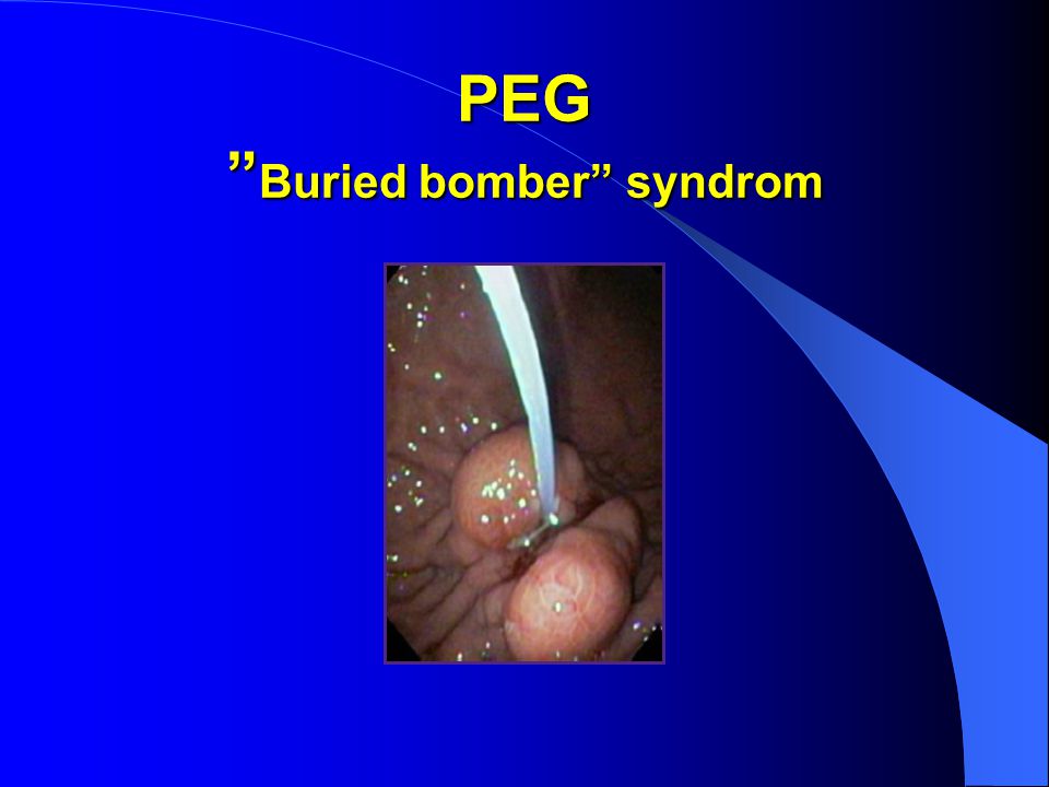 PEG Buried bomber syndrom