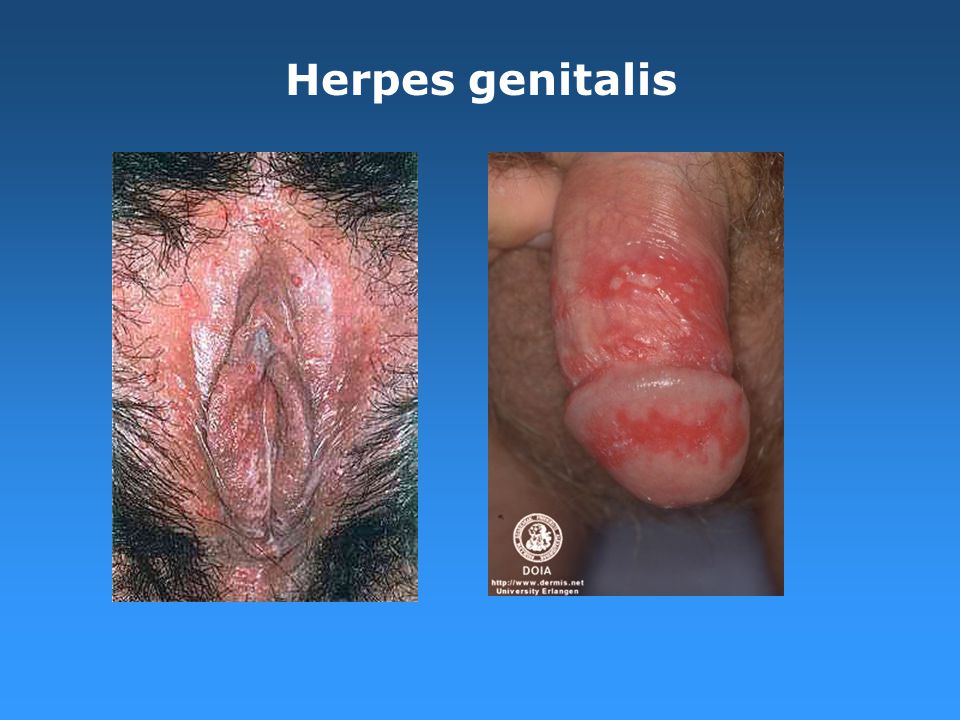 Skeden herpes i Herpes Genitalis
