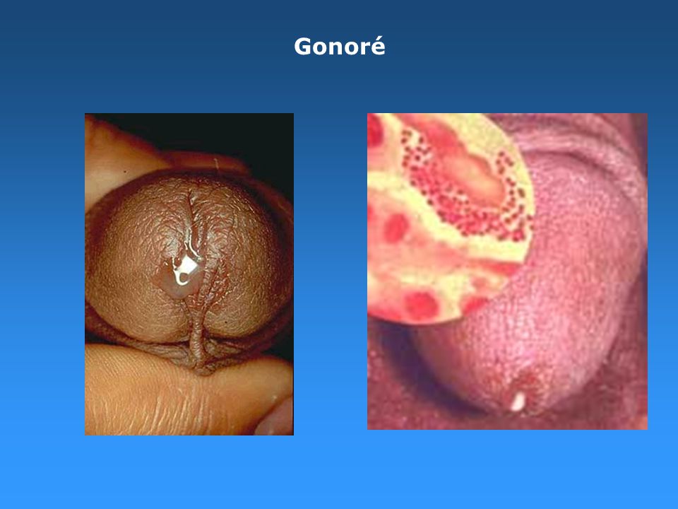 I skeden symptomer herpes Herpes genitalis