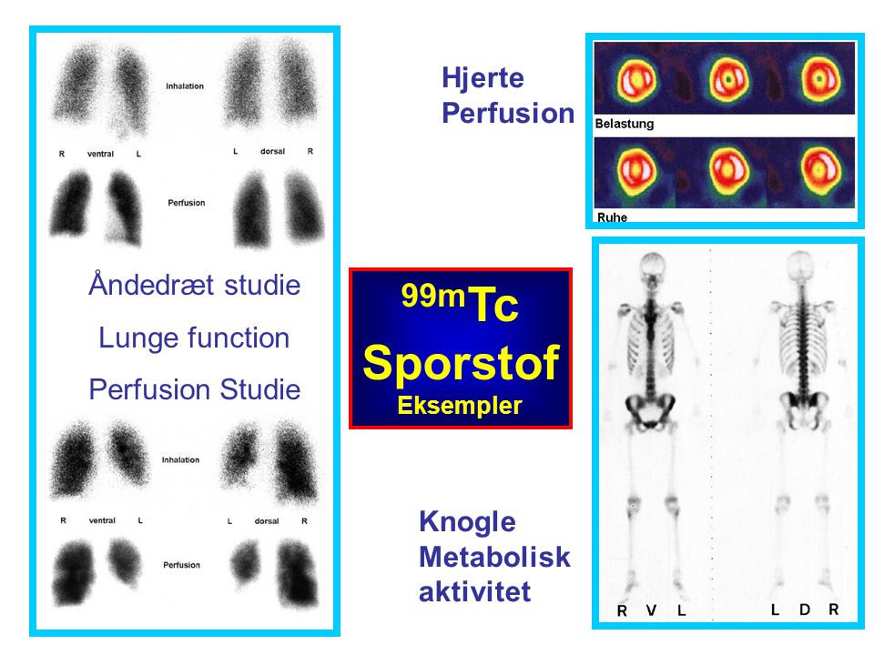 99mTc Sporstof Hjerte Perfusion Åndedræt studie Lunge function