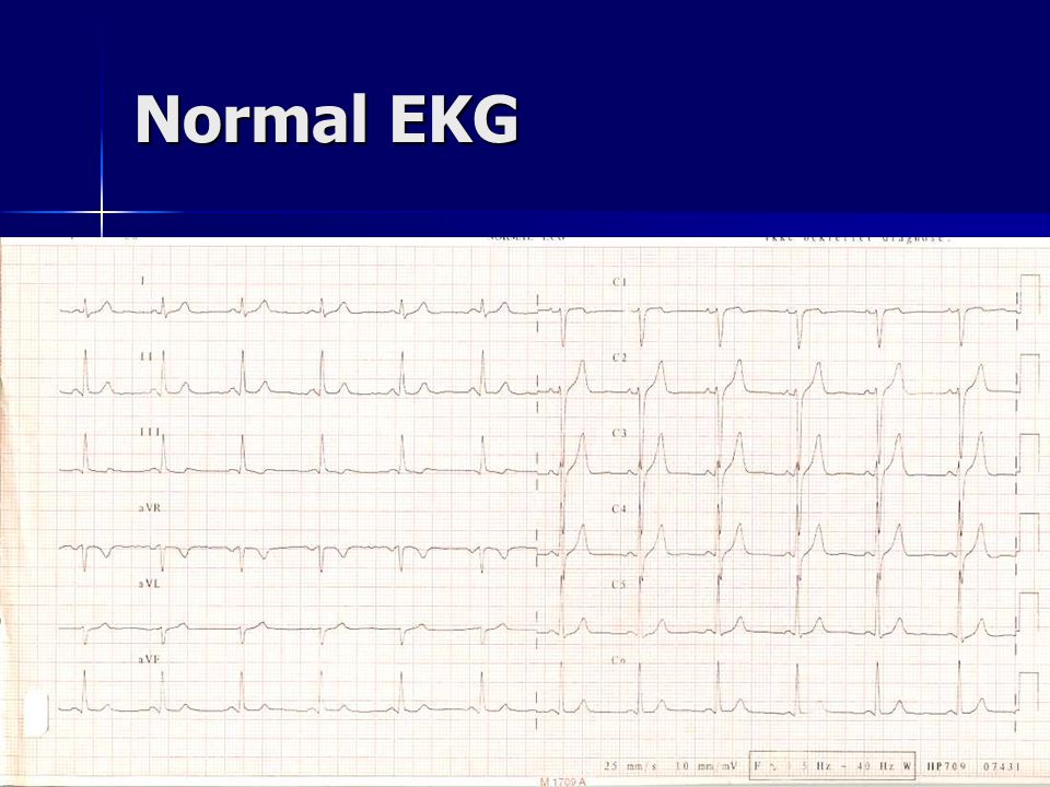 Normal EKG