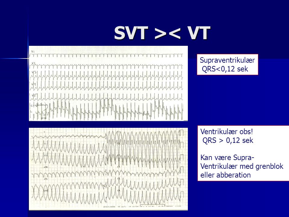 SVT >< VT Supraventrikulær QRS<0,12 sek Ventrikulær obs!