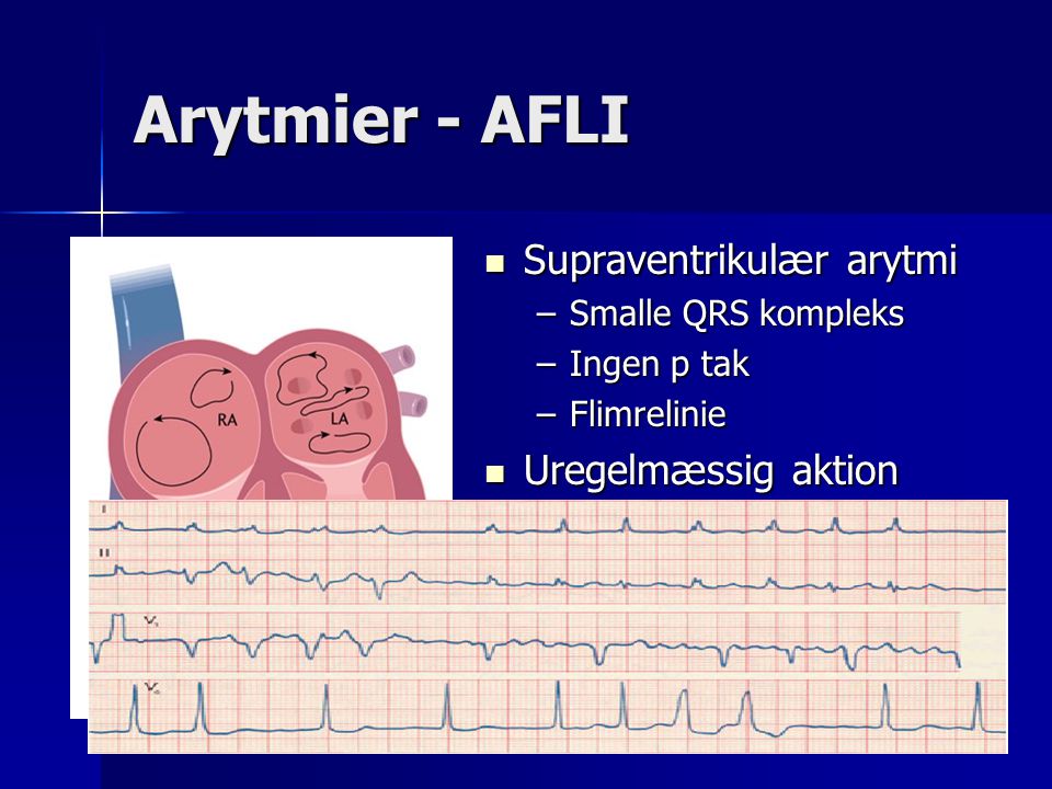 Arytmier - AFLI Supraventrikulær arytmi Uregelmæssig aktion