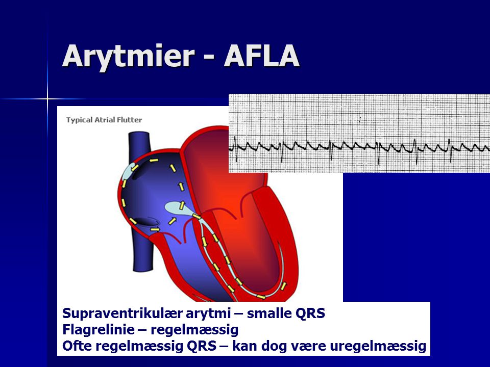 Arytmier - AFLA Supraventrikulær arytmi – smalle QRS