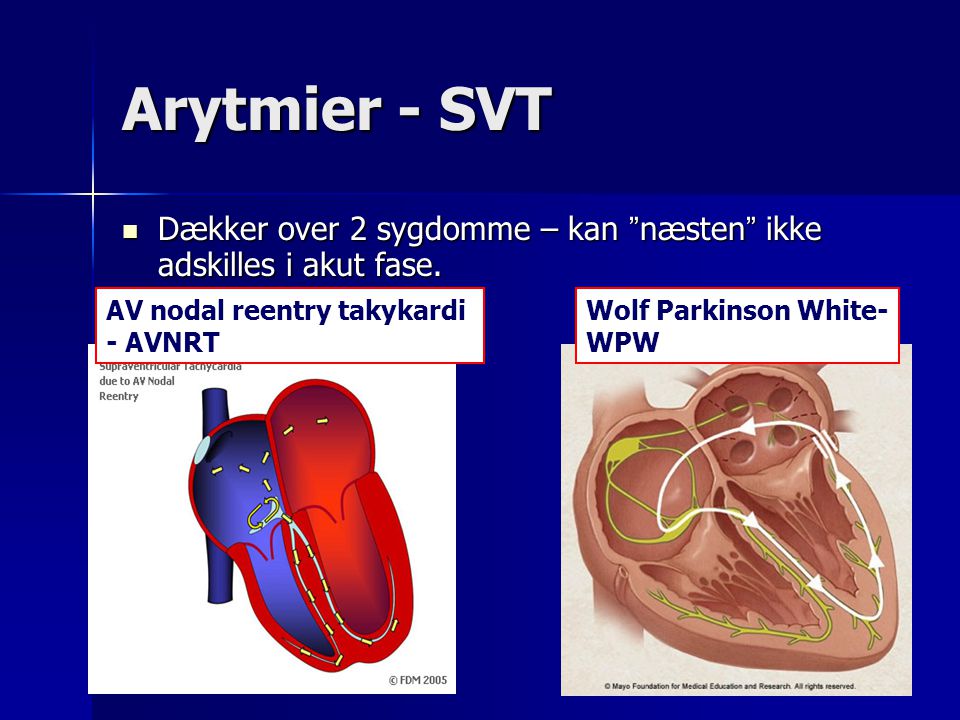 Arytmier - SVT Dækker over 2 sygdomme – kan næsten ikke adskilles i akut fase. AV nodal reentry takykardi.