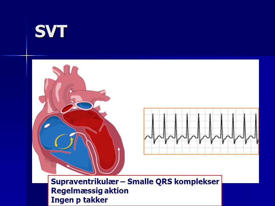 SVT Supraventrikulær – Smalle QRS komplekser Regelmæssig aktion