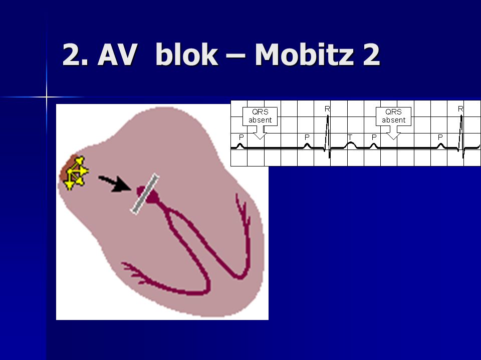 2. AV blok – Mobitz 2