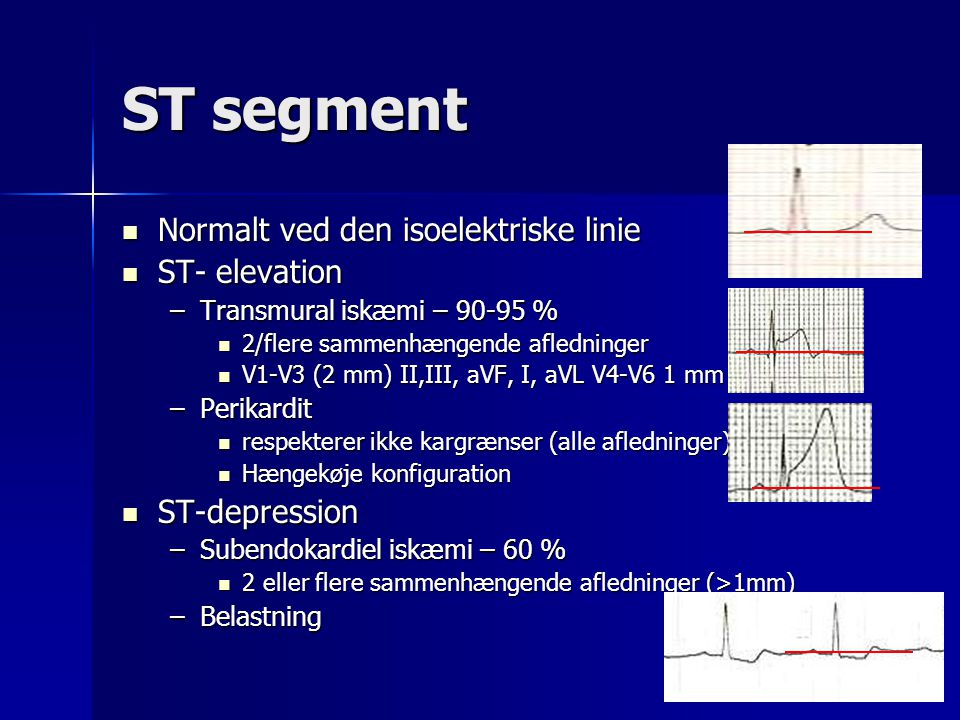 ST segment Normalt ved den isoelektriske linie ST- elevation