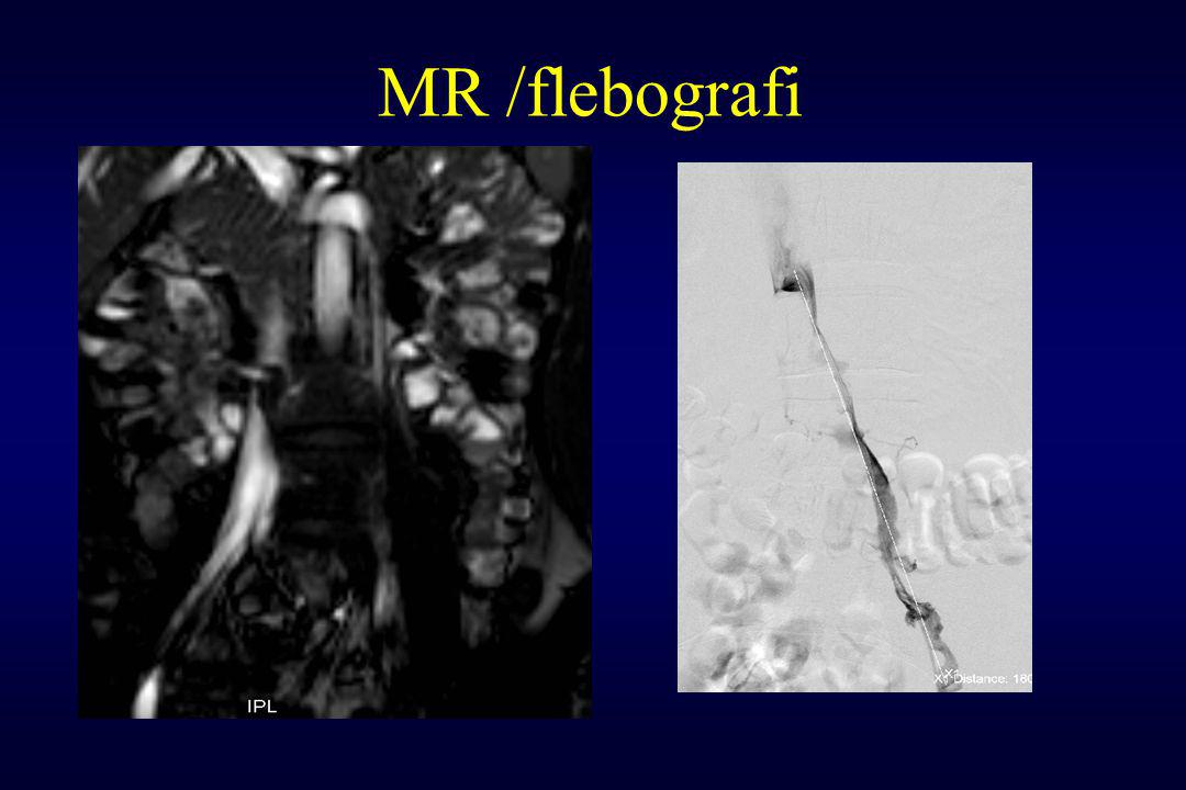 MR /flebografi