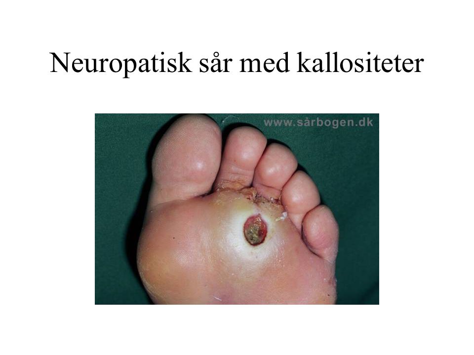 Neuropatisk sår med kallositeter