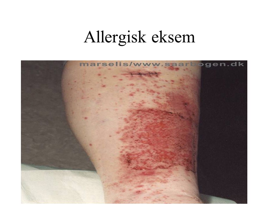 Allergisk eksem