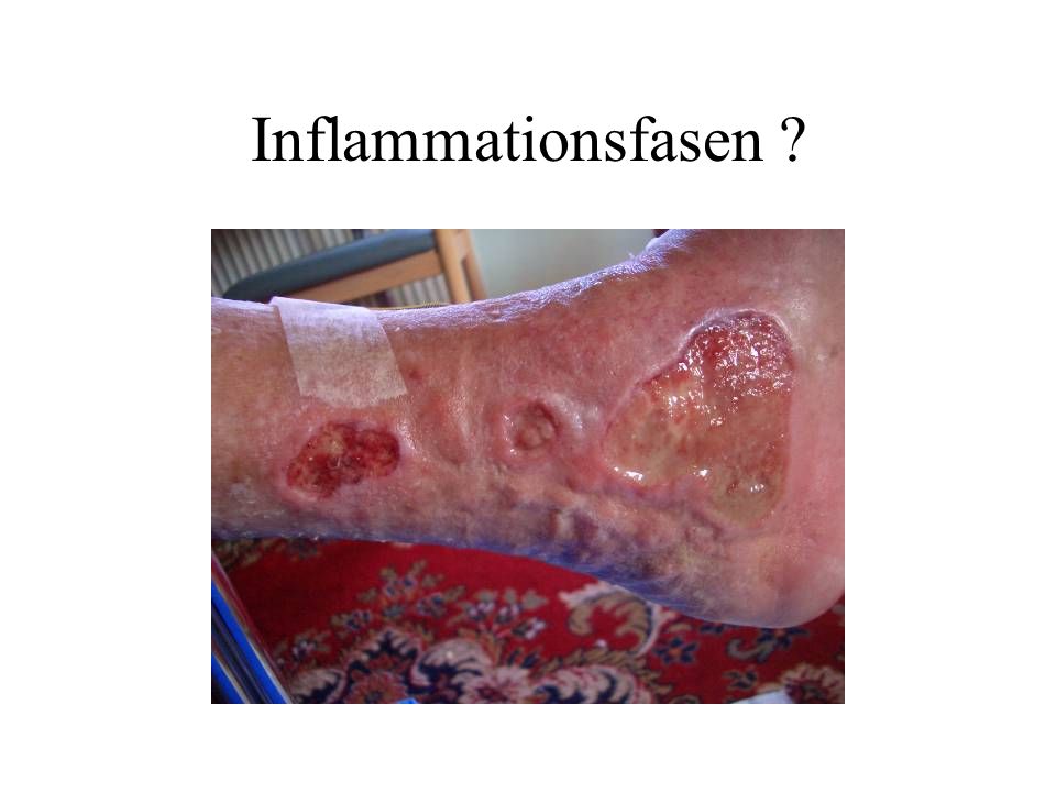Inflammationsfasen