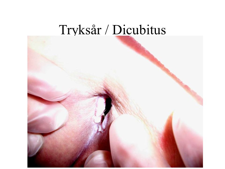 Tryksår / Dicubitus