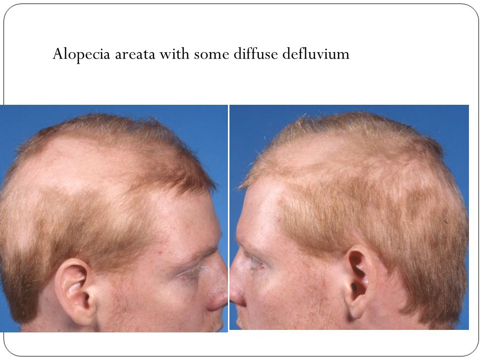 Alopecia areata with some diffuse defluvium