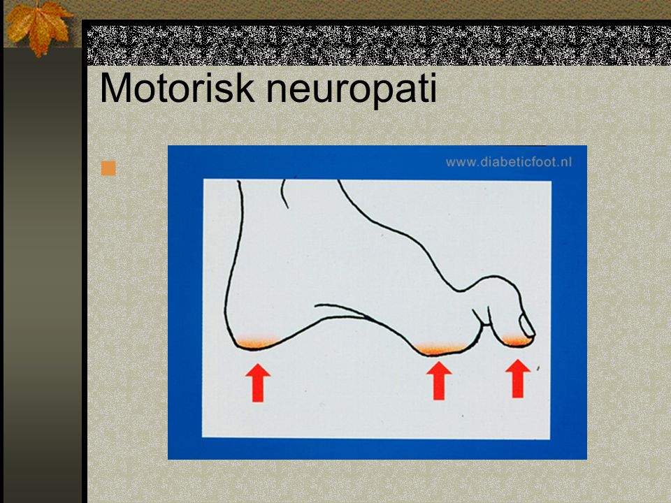 Motorisk neuropati