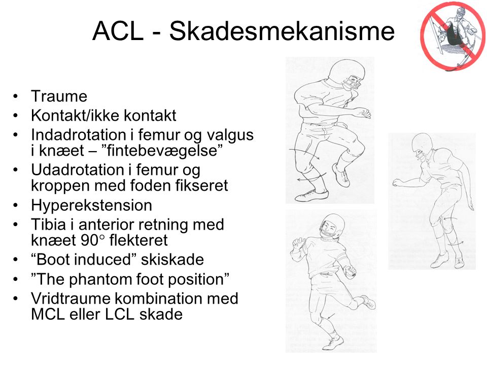 ACL - Skadesmekanisme Traume Kontakt/ikke kontakt