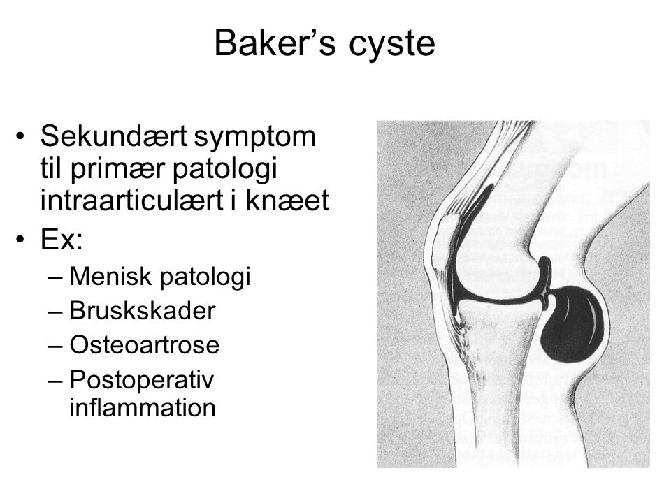 Baker’s cyste Sekundært symptom til primær patologi intraarticulært i knæet. Ex: Menisk patologi.