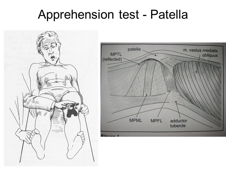 Apprehension test - Patella