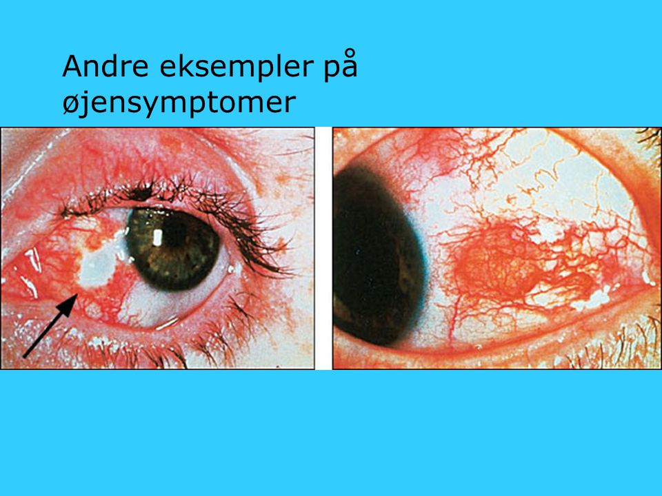 Andre eksempler på øjensymptomer