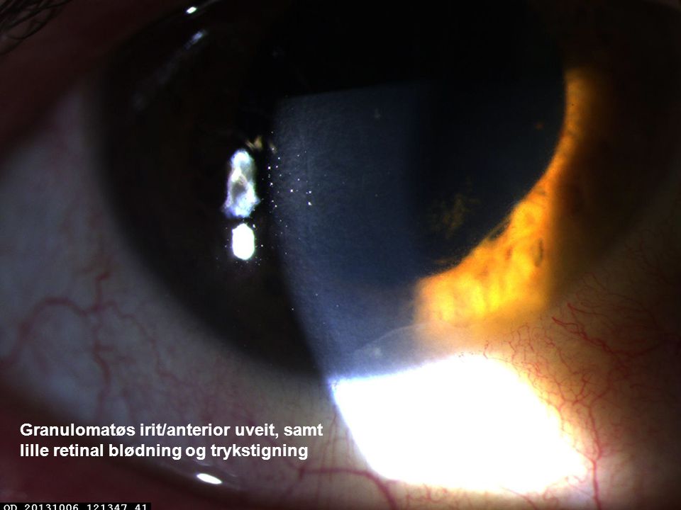 Granulomatøs irit/anterior uveit, samt lille retinal blødning og trykstigning
