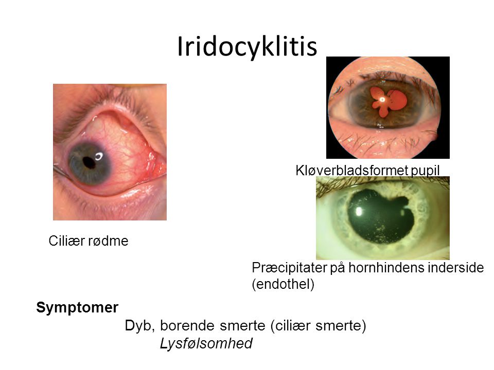 Iridocyklitis Symptomer