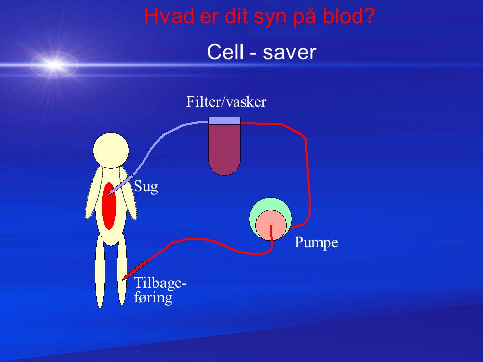 Hvad er dit syn på blod Cell - saver Filter/vasker Sug Pumpe Tilbage-