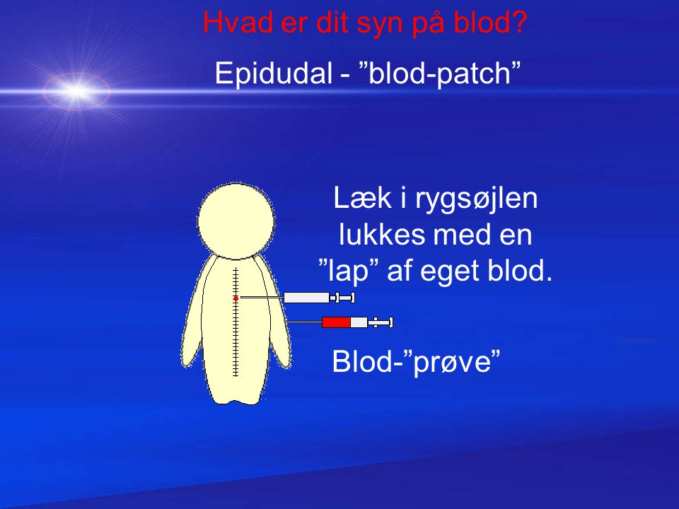 Epidudal - blod-patch