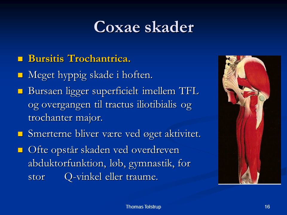 Coxae skader Bursitis Trochantrica. Meget hyppig skade i hoften.