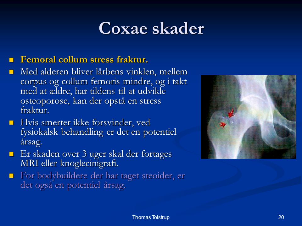 Coxae skader Femoral collum stress fraktur.
